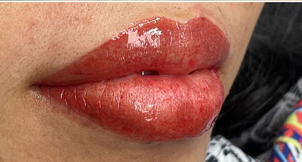 Lip treatment after
