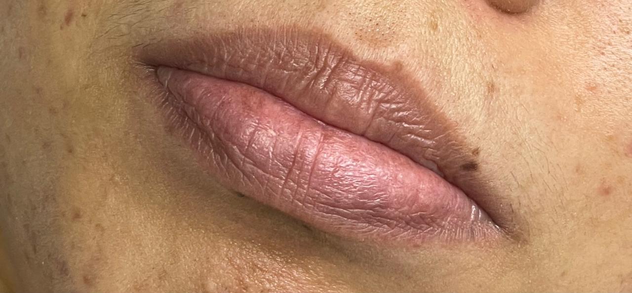 Lip treatment before